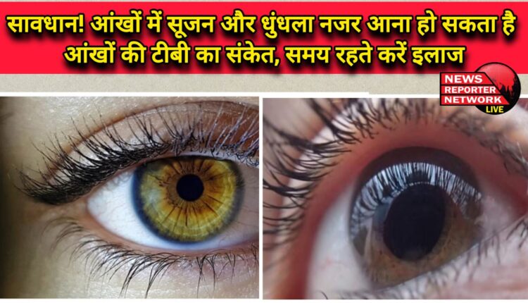 Caution! Swelling in the eyes and blurred vision can be a sign of eye TB, treat it in time